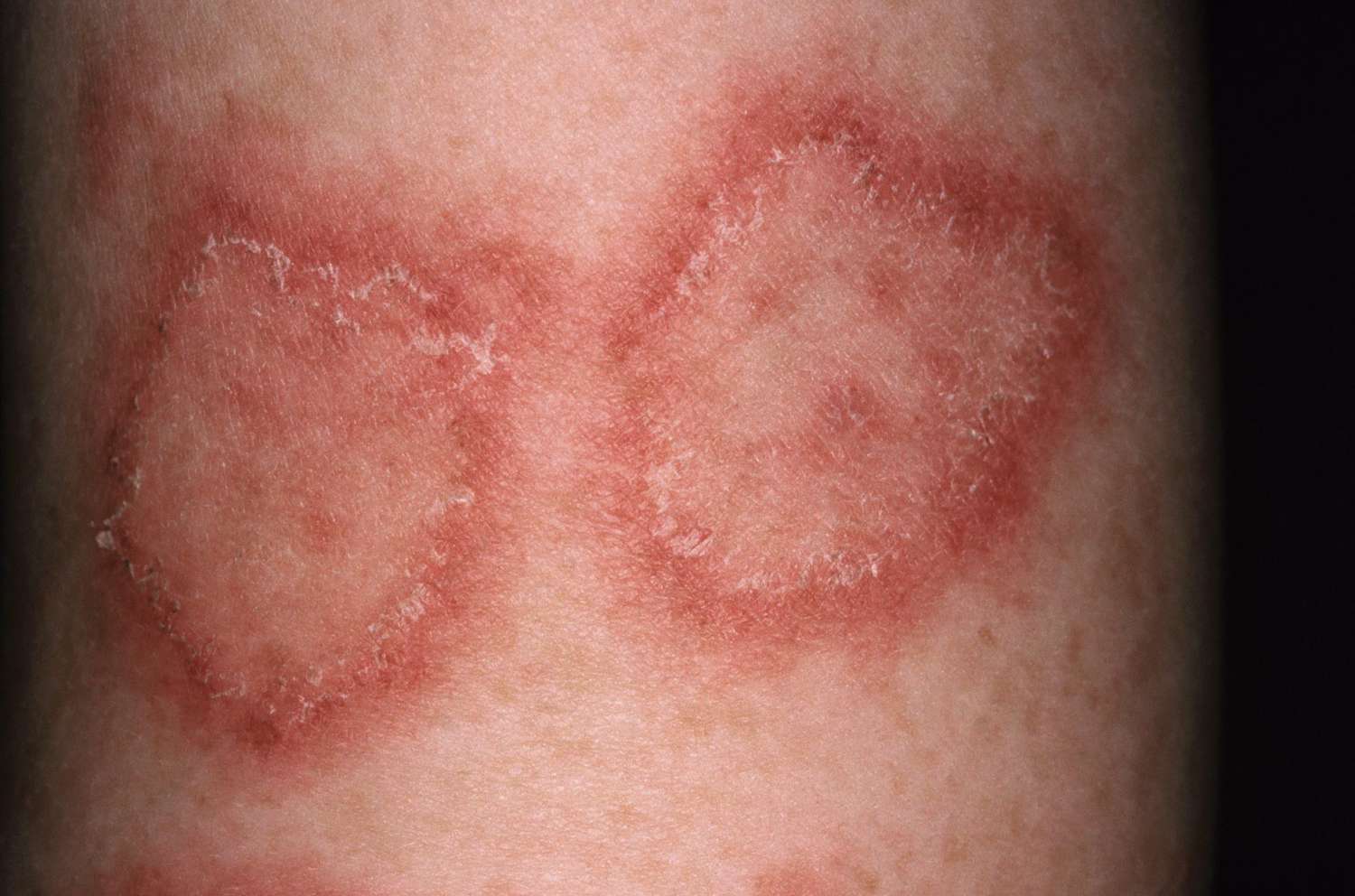 Skin Diseases